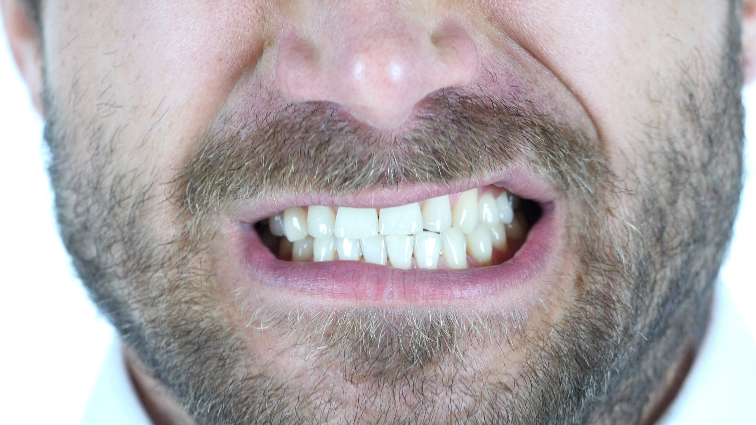 Dentiste_Beauport_Bruxisme_traitement