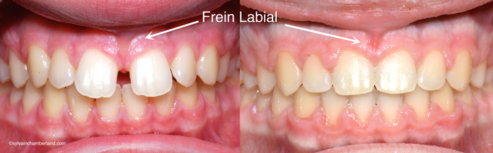 Diasteme-ferme-sans-frenectomie-Chamberland-Orthodontiste-a-Quebec