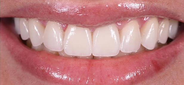 Sourire 05-after