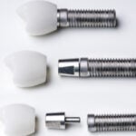 Photographie décomposée d'implants dentaires