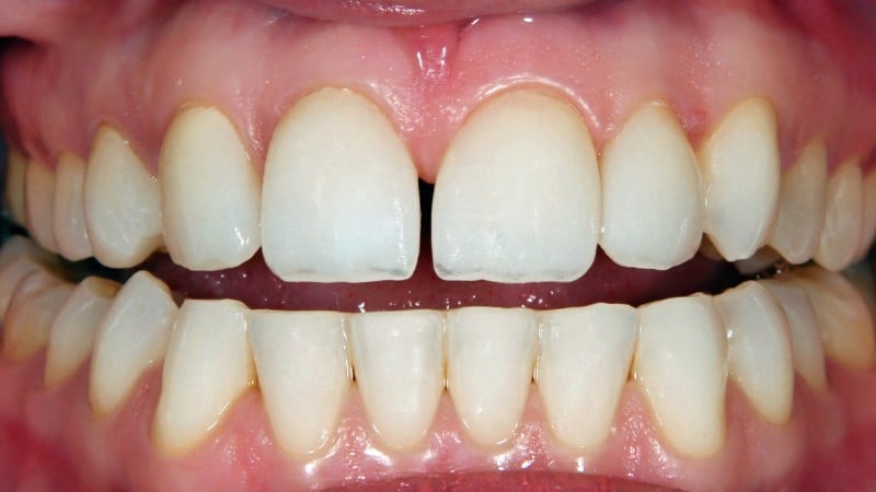 Une coloration des dents inégale à cause d'un mauvais blanchiment dentaire