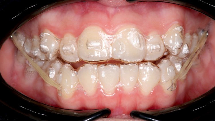 Des taquets Invisalign sur les dents d'un patient