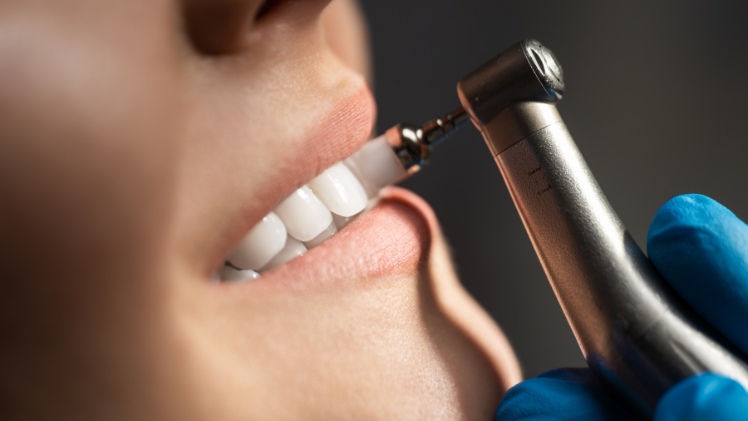 Le nettoyage des dents après le retrait des taquets dentaire