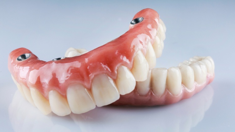 Un bridge complet sur implants dentaires