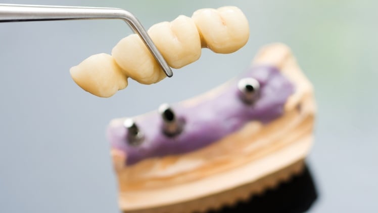 Un bridge dentaire sur implants