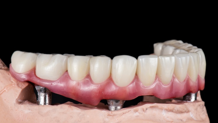Un dentier fixe sur implant