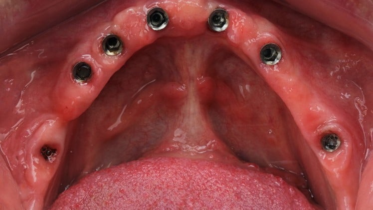 Une machoire prête pour une prothèse dentaire sur implant