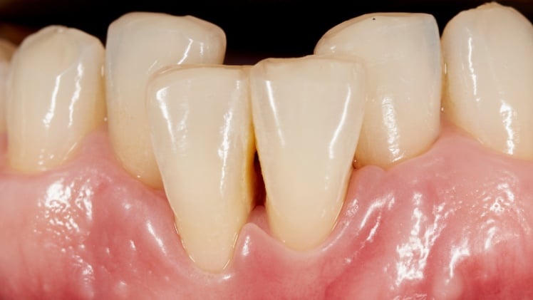 Un encombrement dentaire nécessitant un appareil pour redresser les dents