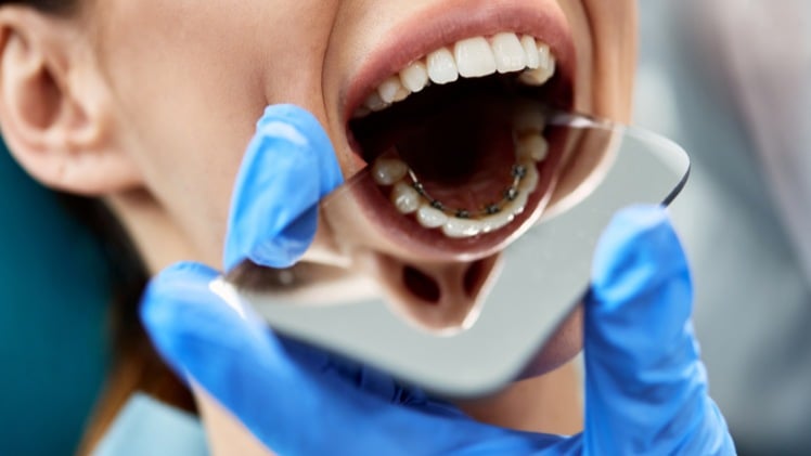 Un traitement dentaire d'orthodontie linguale