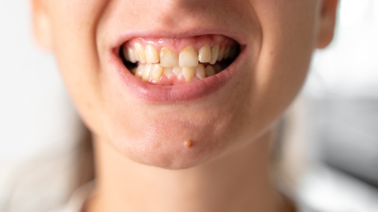 Une femme avec une mauvaise hygiène dentaire