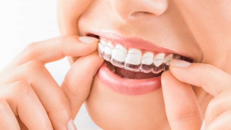 Une femme qui porte une gouttière dentaire pour redresser des dents sans bagues