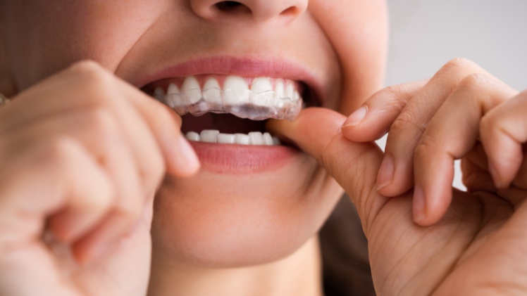 Une patiente en train de mettre sa gouttière Invisalign