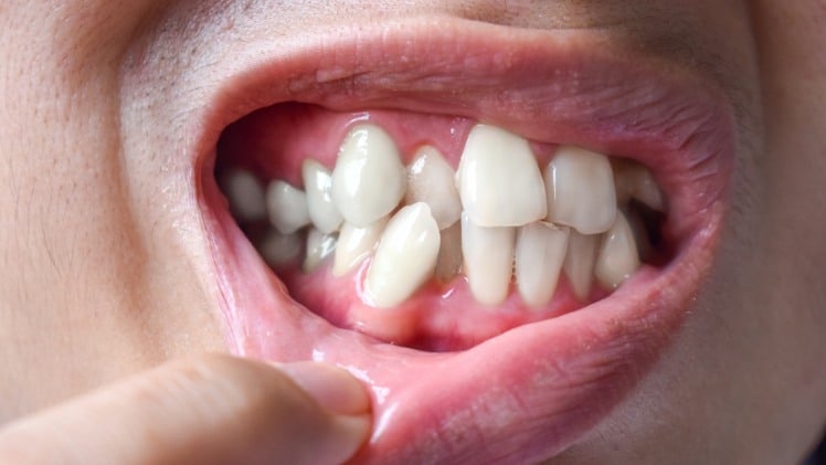 Une personne aux dents mal alignées qui a besoin d'un traitement de redressement