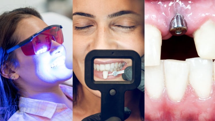 Les différents traitements en dentisterie esthétique