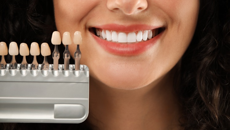 Une femme ayant opté pour des facettes pour son traitement en dentisterie esthétique