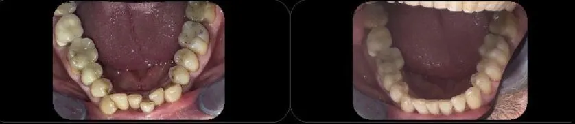 Gouttière dentaire pour redresser les dents - FAS - La Clinique du Sourire Die