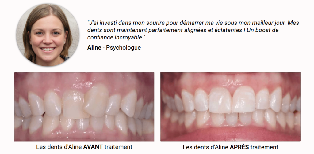 Gouttière pour redresser les dents - Invisalign-Avis client Aline - La Clinique du Sourire Die