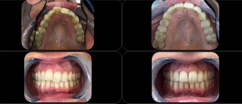 Gouttière pour redresser les dents - avant-après invisalign - La clinique du Sourire Die