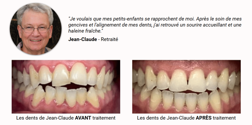 gouttière pour redresser les dents - Invisalign avis client -Jean Claude - La Clinique du Sourire Die